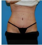 Abdominoplasty before and after - after
