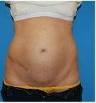 Abdominoplasty before and after - before