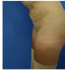 Liposuction before and after - after