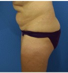 Liposuction before and after - before