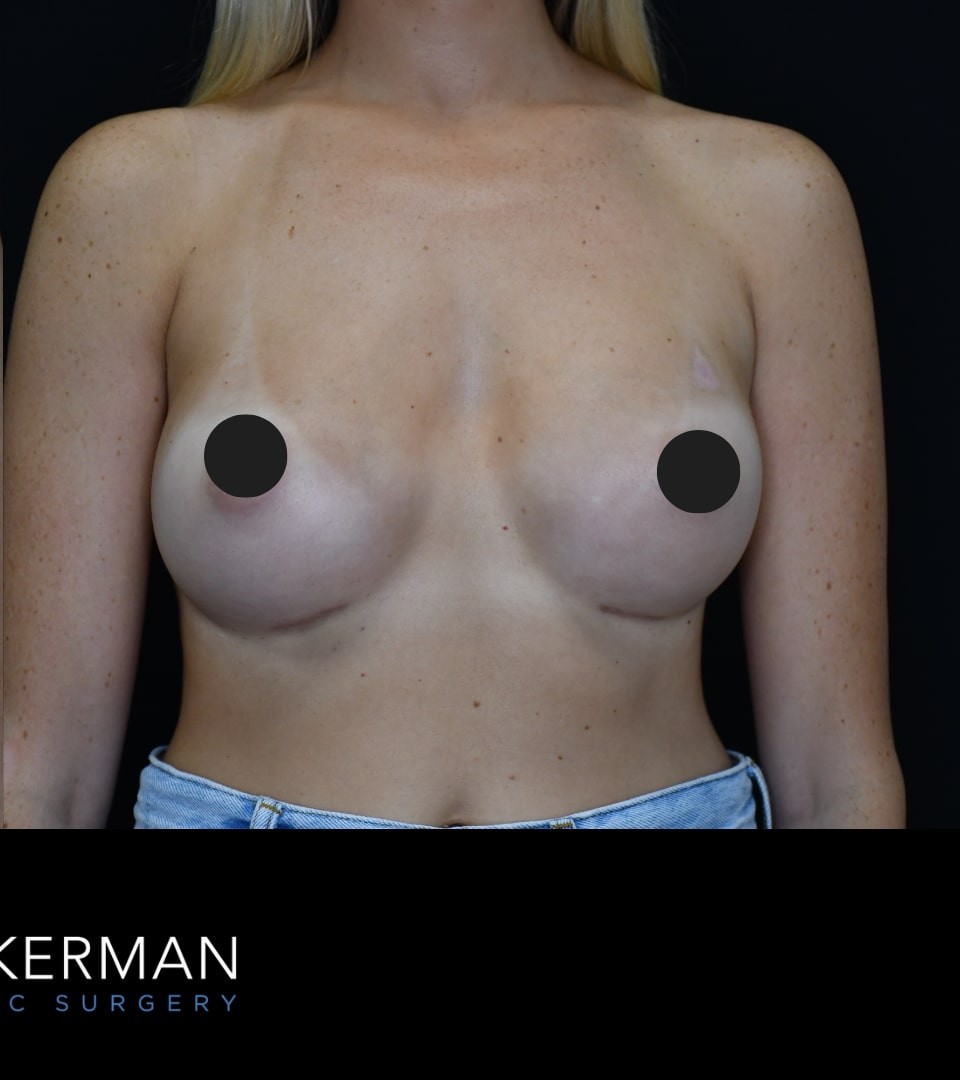 Breast Augmentation after — Dr. Joshua Zuckerman