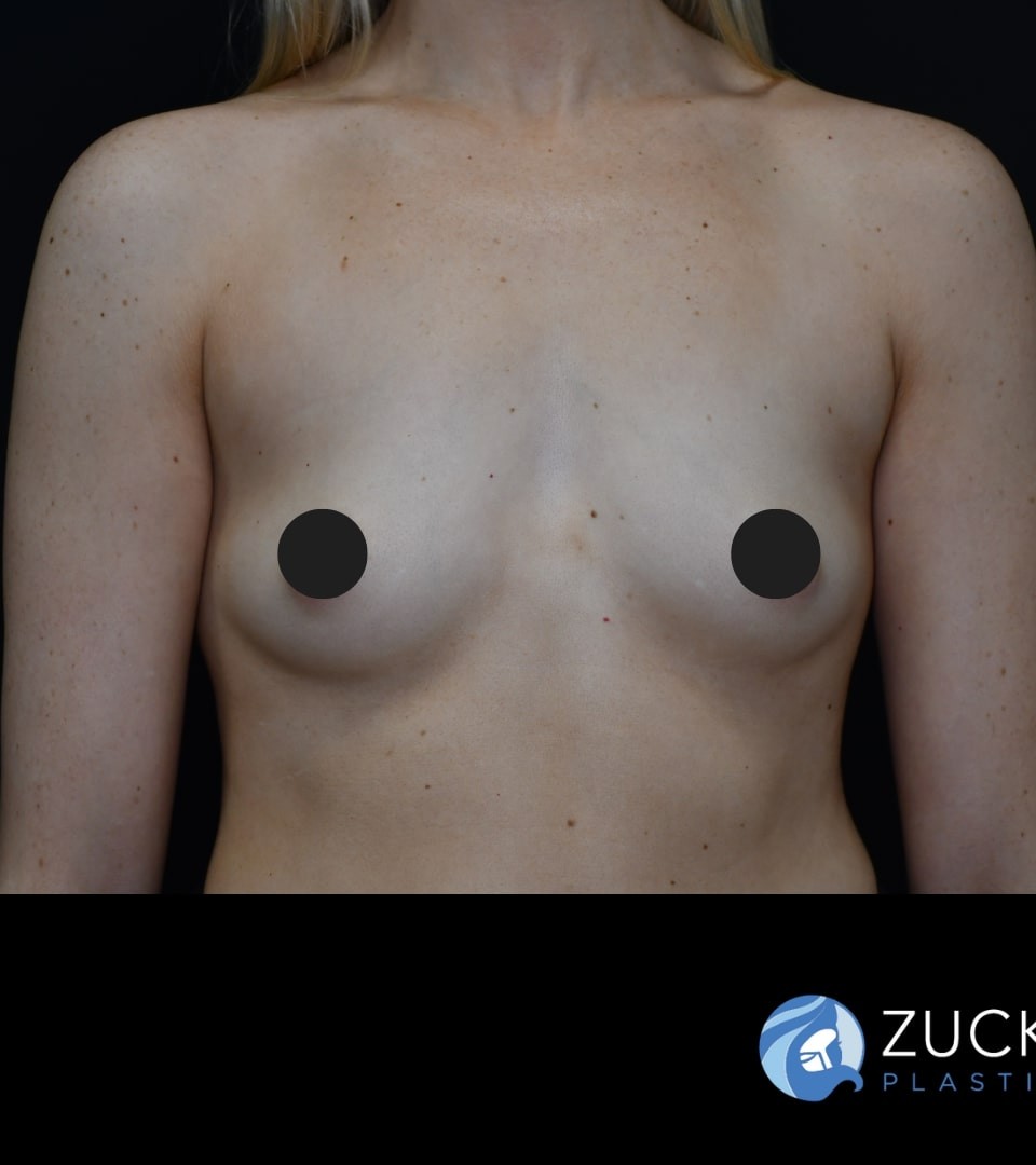 Breast Augmentation and Tummy Tuck (Abdominoplasty) before and after - before