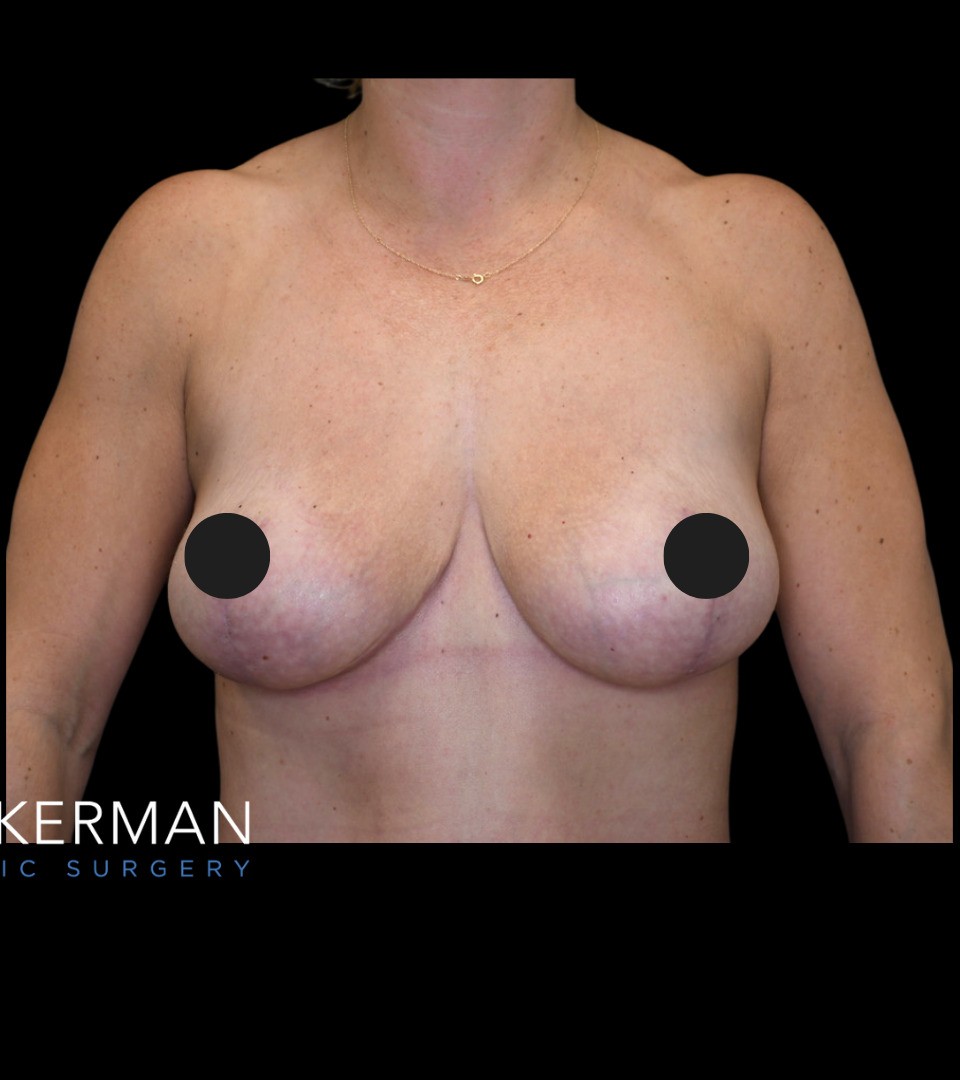 Breast Lift after — Dr. Joshua Zuckerman