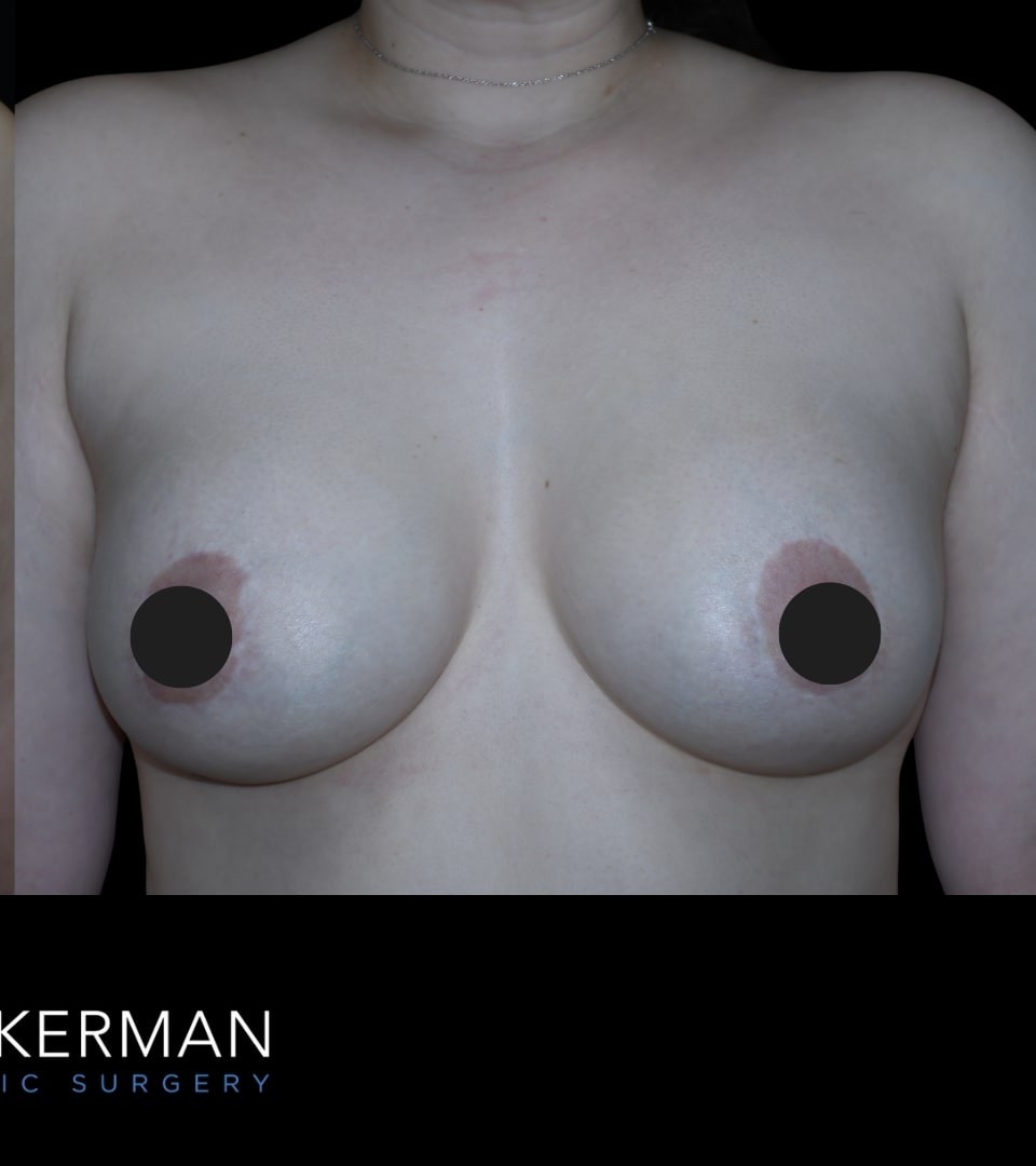 Augmentation Mastopexy before and after - after