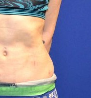Liposuction before and after - after