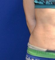 Liposuction before and after - before