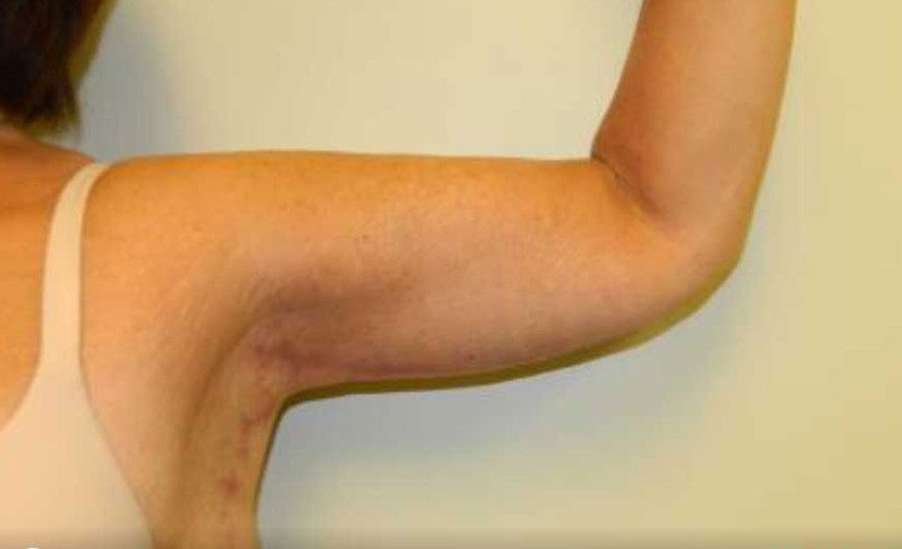 Arm Lift after — Dr. Cristina Dracea