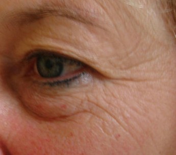 Blepharoplasty before and after - after