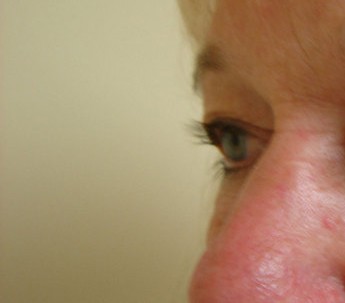 Blepharoplasty before and after - before