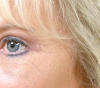 Blepharoplasty before and after - after