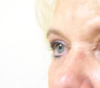 Blepharoplasty before and after - before