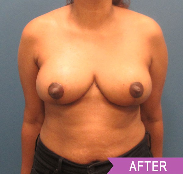 Breast Reduction after — Dr. Lawrence Lin
