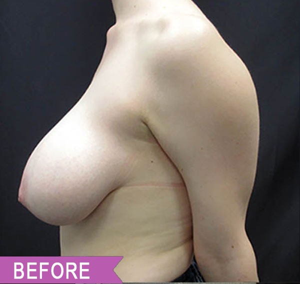 Breast Reduction before — Dr. Lawrence Lin