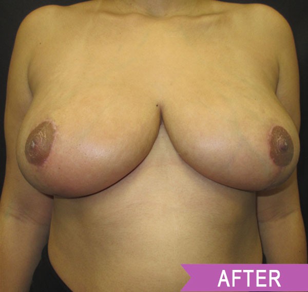 Breast Reduction after — Dr. Lawrence Lin
