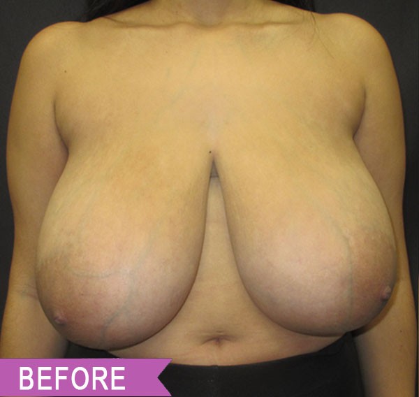 Breast Reduction before — Dr. Lawrence Lin