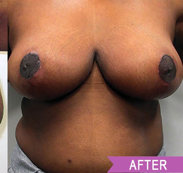 Breast Reduction after — Dr. Lawrence Lin