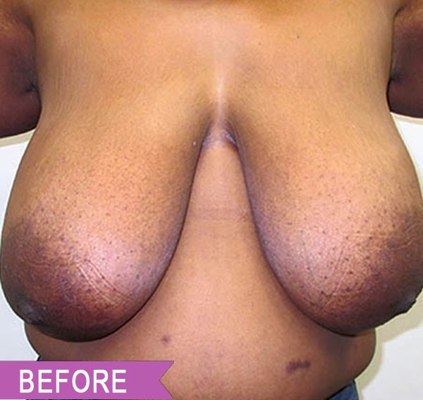 Breast Reduction before — Dr. Lawrence Lin