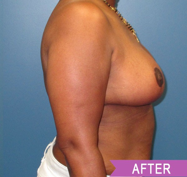 Breast Reduction after — Dr. Lawrence Lin