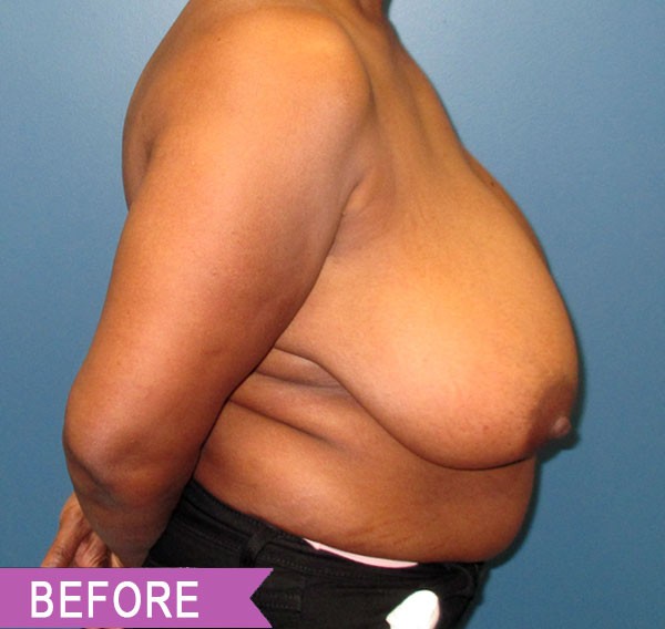 Breast Reduction before — Dr. Lawrence Lin
