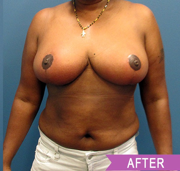 Breast Reduction after — Dr. Lawrence Lin