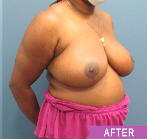 Breast Reduction after — Dr. Lawrence Lin