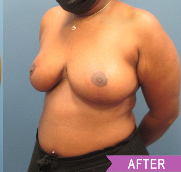 Breast Reduction after — Dr. Lawrence Lin