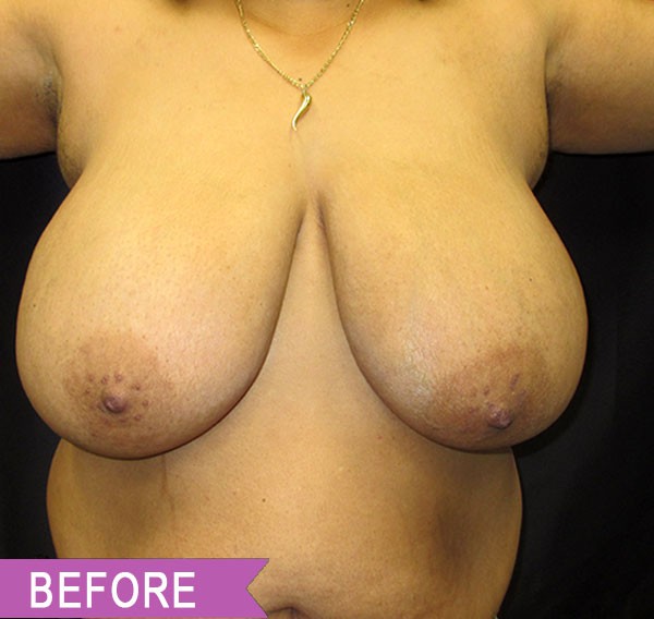 Breast Reduction before — Dr. Lawrence Lin