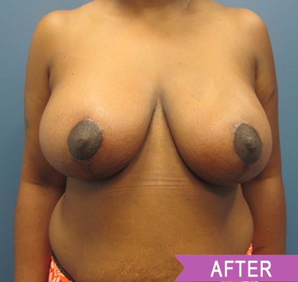 Breast Reduction after — Dr. Lawrence Lin