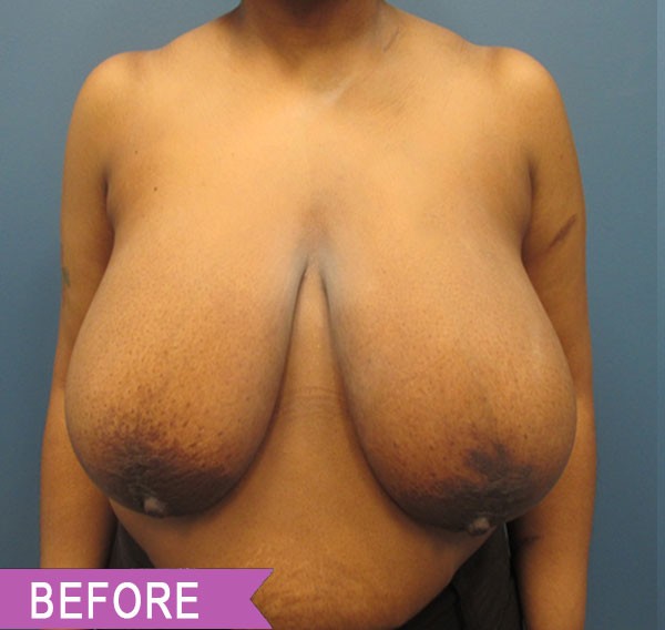 Breast Reduction before — Dr. Lawrence Lin