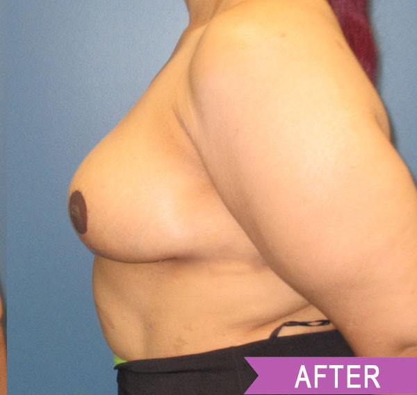 Breast Reduction after — Dr. Lawrence Lin