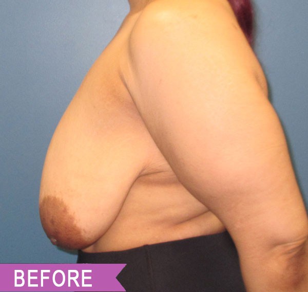 Breast Reduction before — Dr. Lawrence Lin