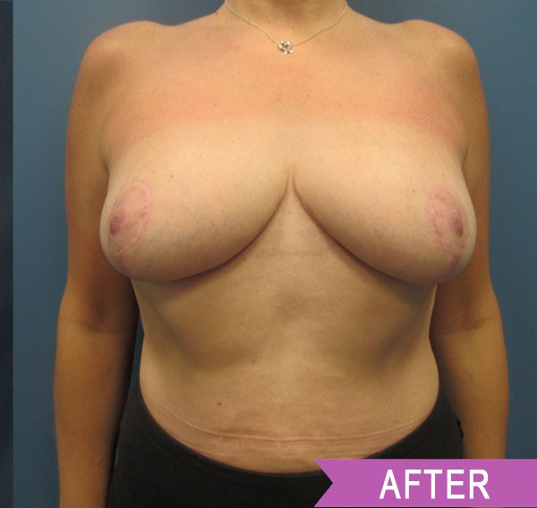 Breast Reduction after — Dr. Lawrence Lin