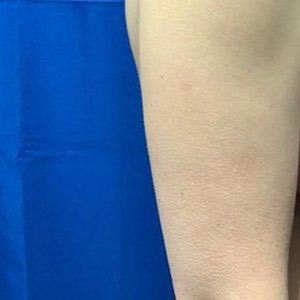 Breast Reduction before and after - before