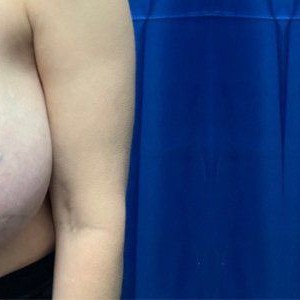 Breast Reduction before and after - after