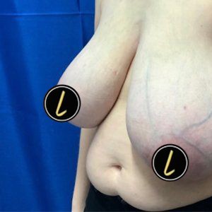 Breast Reduction before and after - before