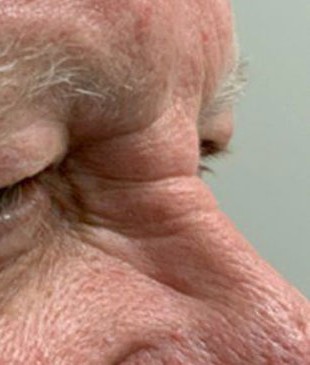 Upper Eyelid Surgery before and after - after
