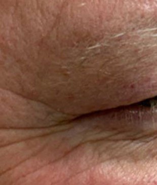 Upper Eyelid Surgery before and after - before