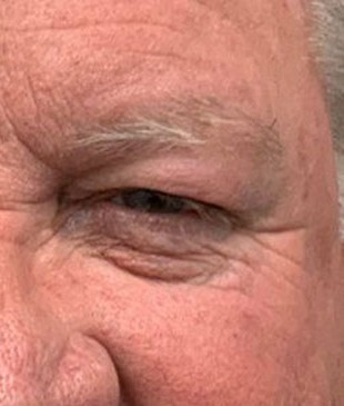 Upper Eyelid Surgery before and after - after