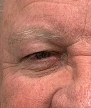 Upper Eyelid Surgery before and after - before