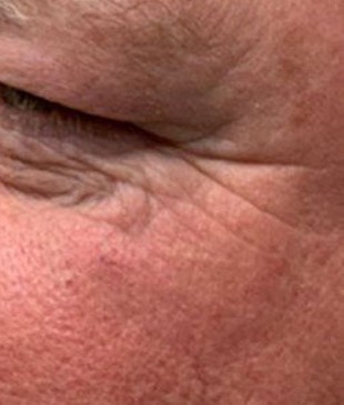 Upper Eyelid Surgery before and after - after