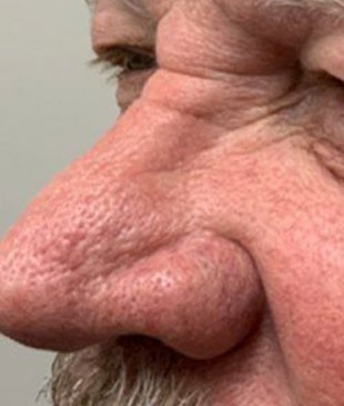 Upper Eyelid Surgery before and after - before