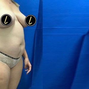 Mommy Makeover before and after - after
