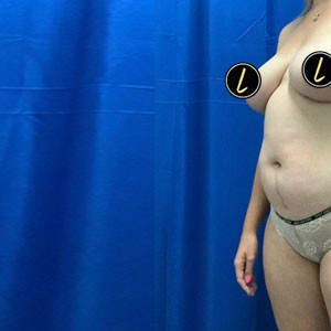 Mommy Makeover before and after - before
