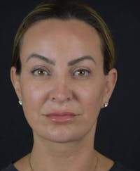 Brow Lift before and after - after