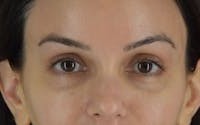 Brow Lift before and after - after