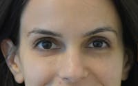 Brow Lift before and after - before