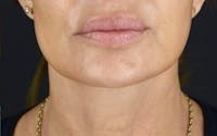 Brow Lift before and after - after