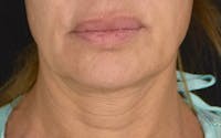 Brow Lift before and after - before
