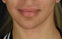 Facelift before and after - after