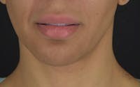 Facelift before and after - before
